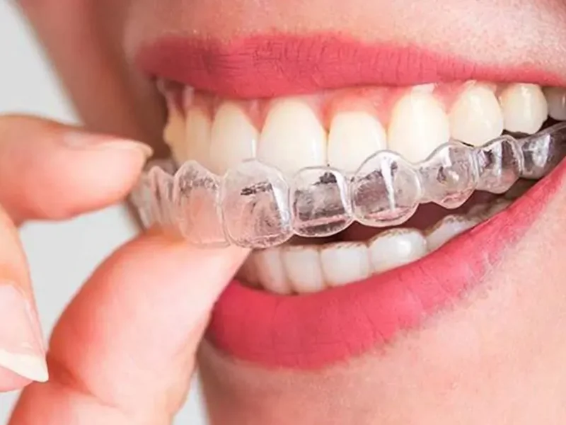 Invisalign